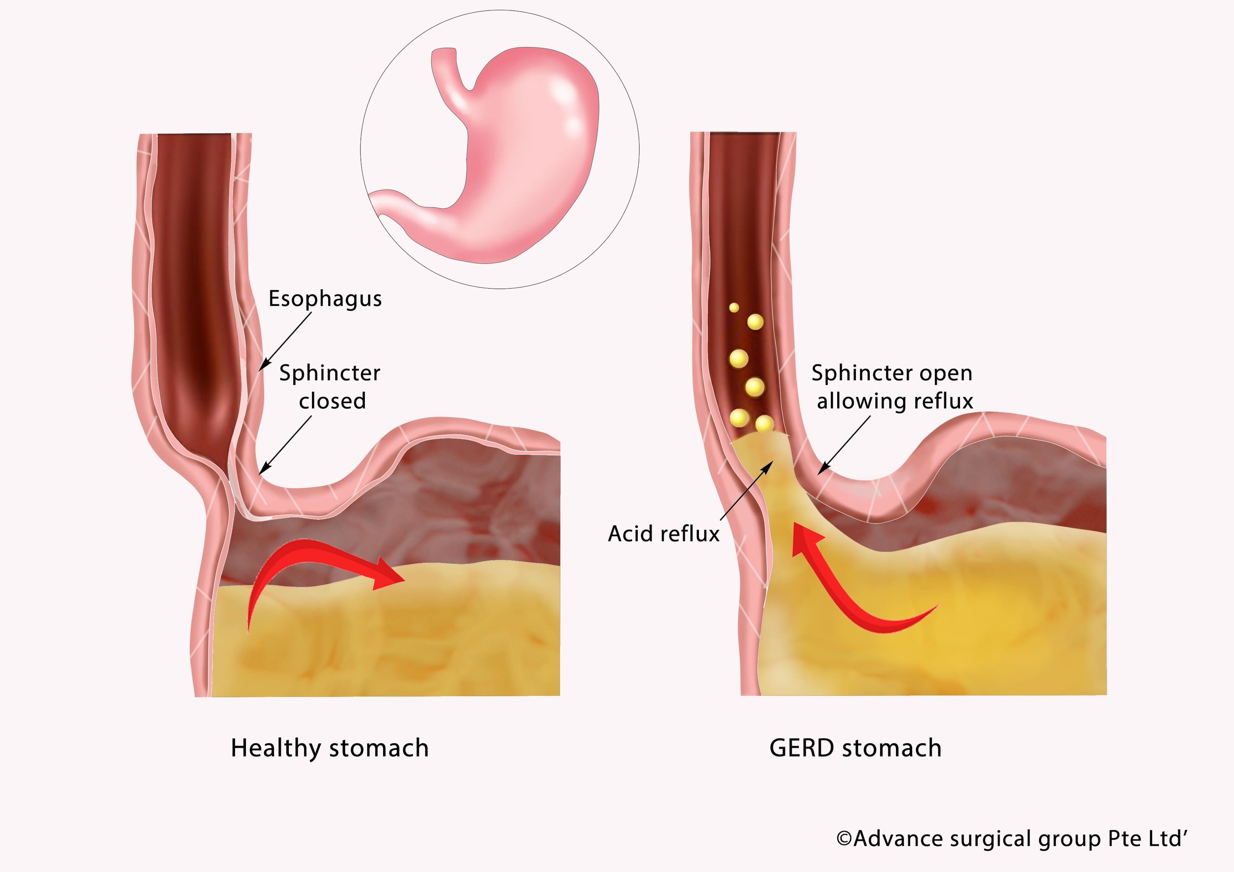 GERD (acid reflux ) Surgeon in Singapore | Causes & Symptoms